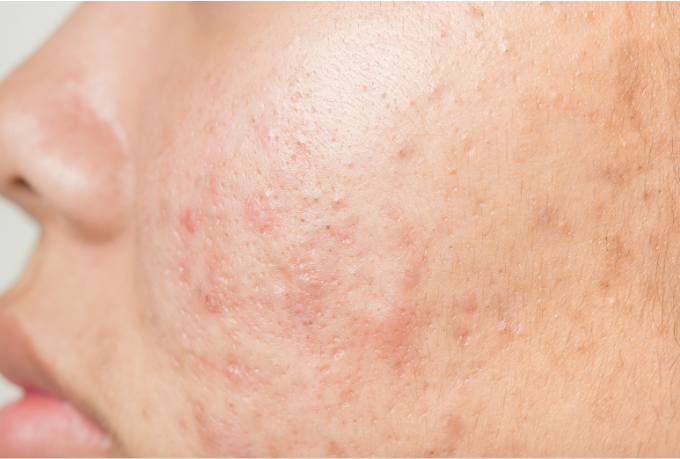 acne issue